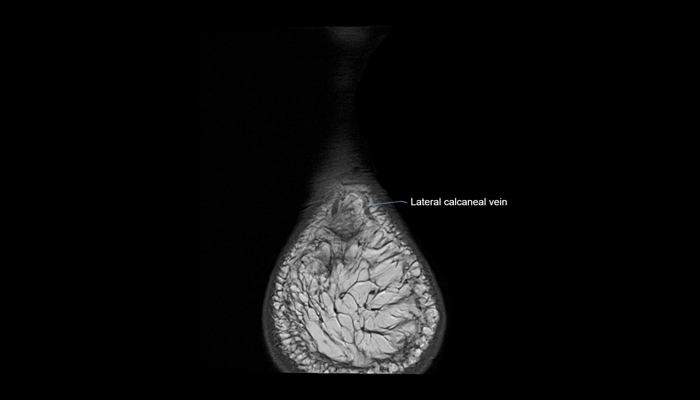 Ankle coronal anatomy 3T MRI images -img-11001-00033.webp